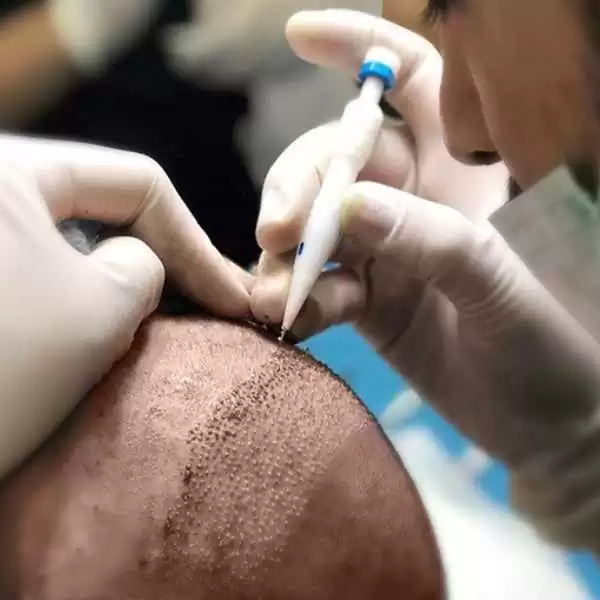 زراعة الشعر في تركيا