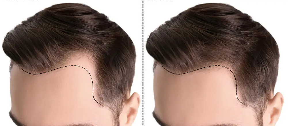 زراعة الشعر في تركيا